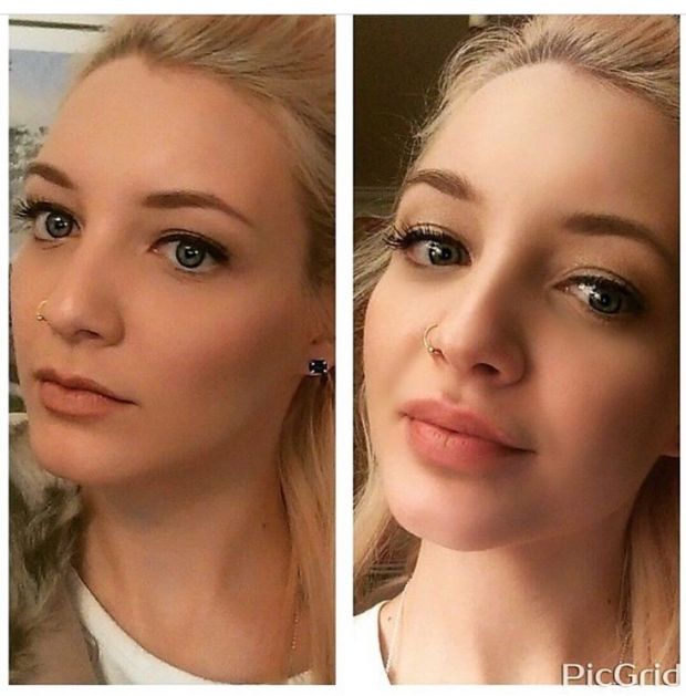 Before and after: Lip Filler Edition 
