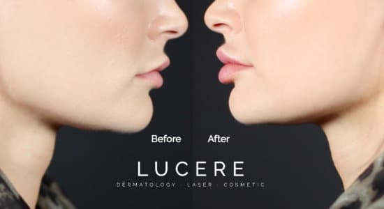 Before and after: Lip Filler Edition 