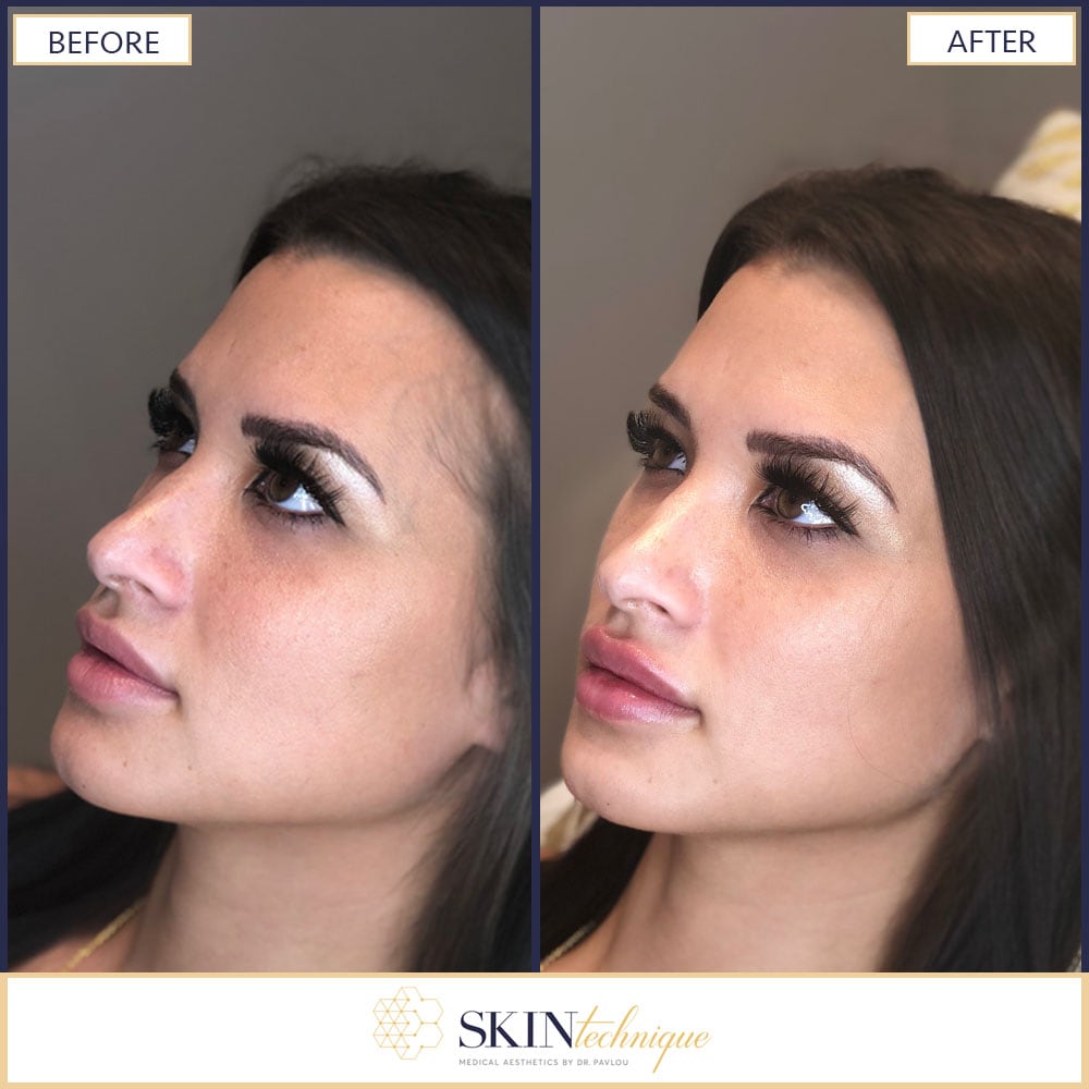 Before and after: Lip Filler Edition 