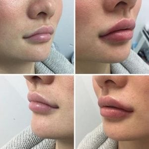 Before and after: Lip Filler Edition 