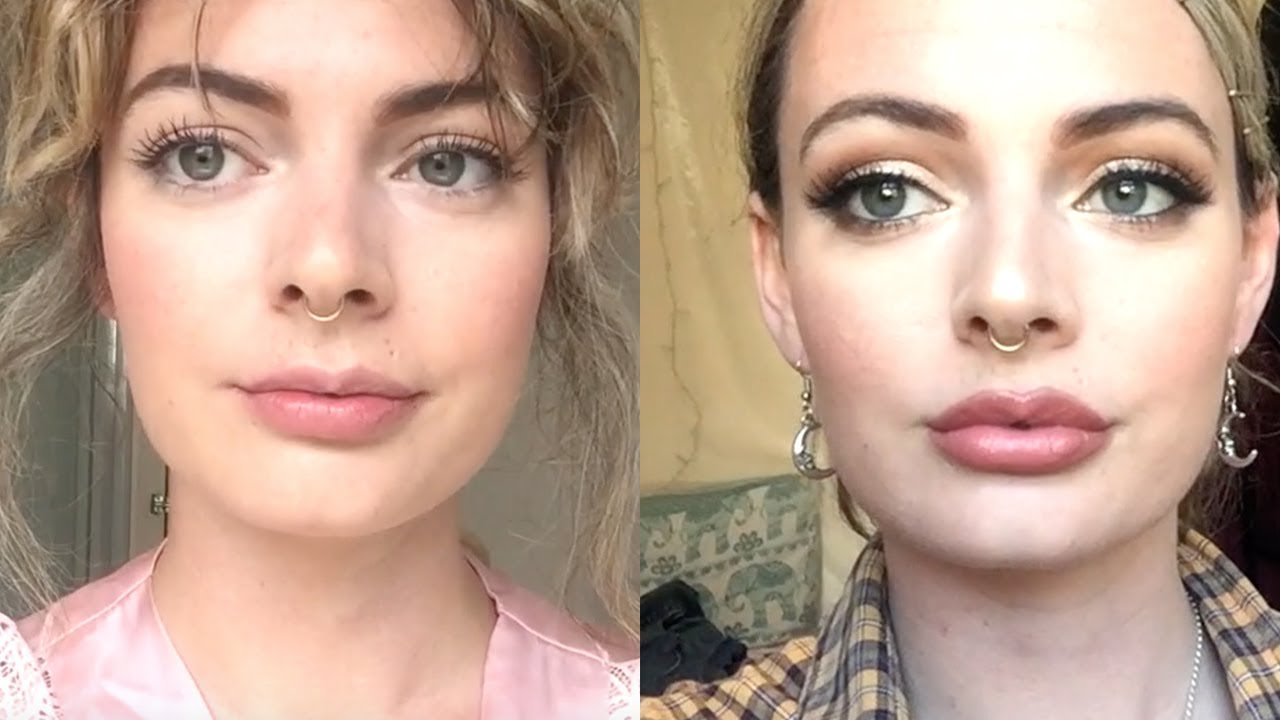 Before and after: Lip Filler Edition 