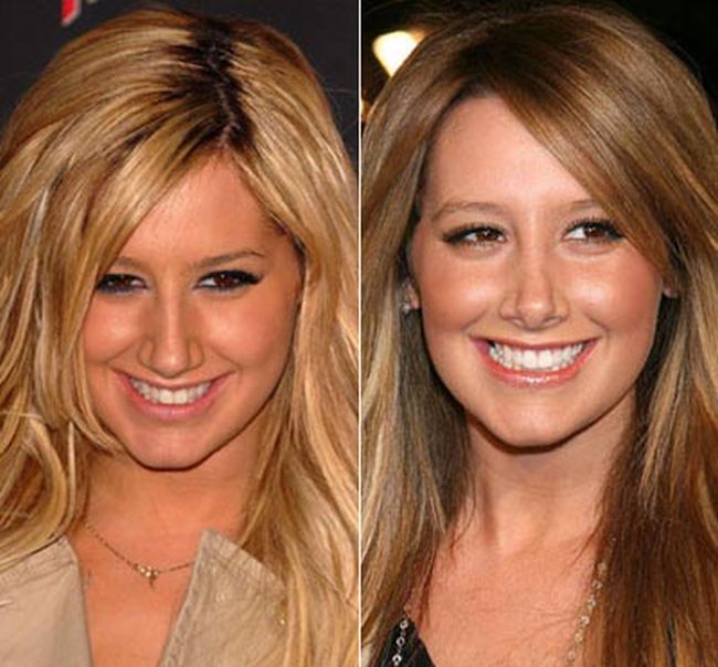 Celebrities Botox Before and After