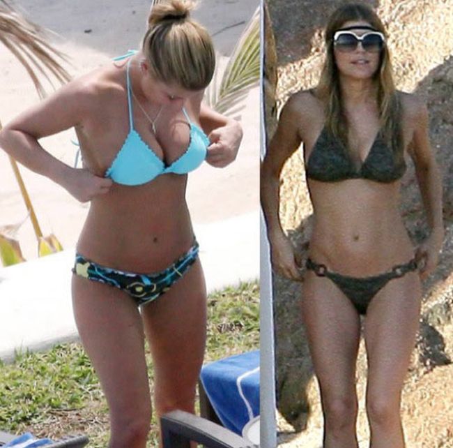Celebrities Botox Before and After