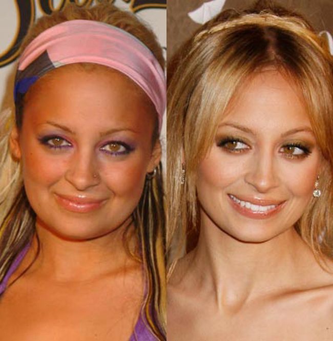 Celebrities Botox Before and After