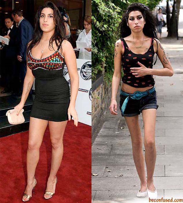 Celebrities Botox Before and After