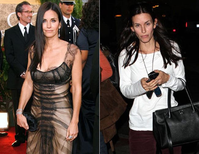 Celebrities Botox Before and After
