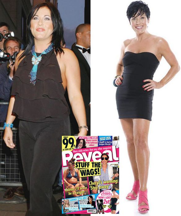 Celebrities Botox Before and After