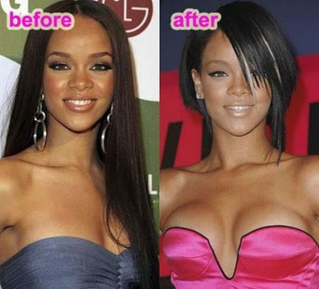 Celebrities Botox Before and After
