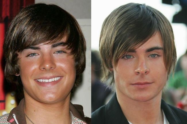 Celebrities Botox Before and After