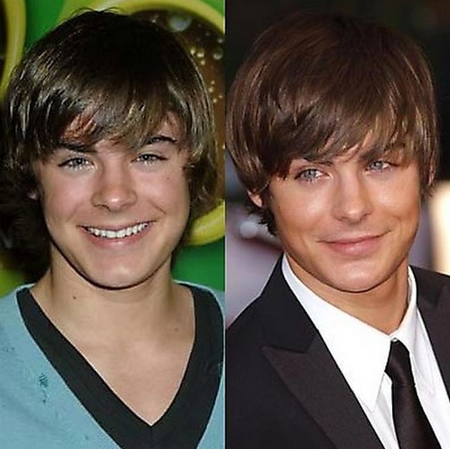 Celebrities Botox Before and After