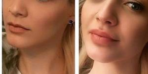 Before and after: Lip Filler Edition 